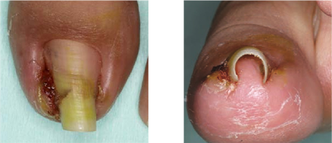 爪の周りに炎症を伴っている場合