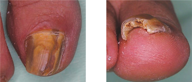 爪白癬を合併している場合
