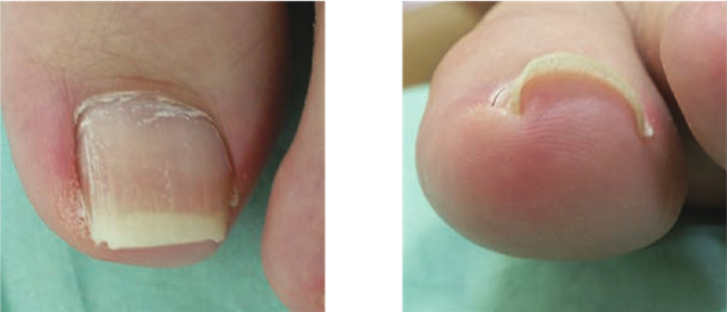 爪の厚みが薄い場合